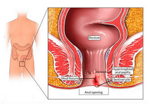 obat fistula ani ambefree